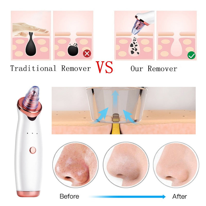 Electric Facial Blackhead Remover Vacuum Machine